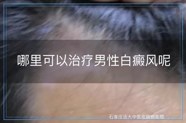 哪里可以治疗男性白癜风呢