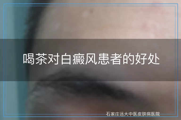 喝茶对白癜风患者的好处