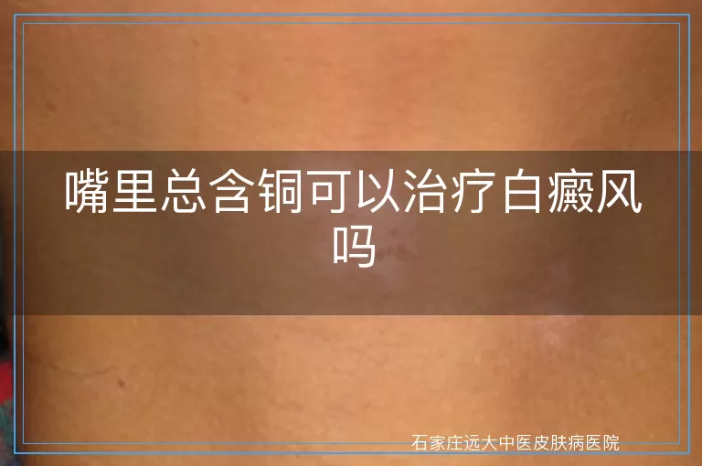 嘴里总含铜可以治疗白癜风吗