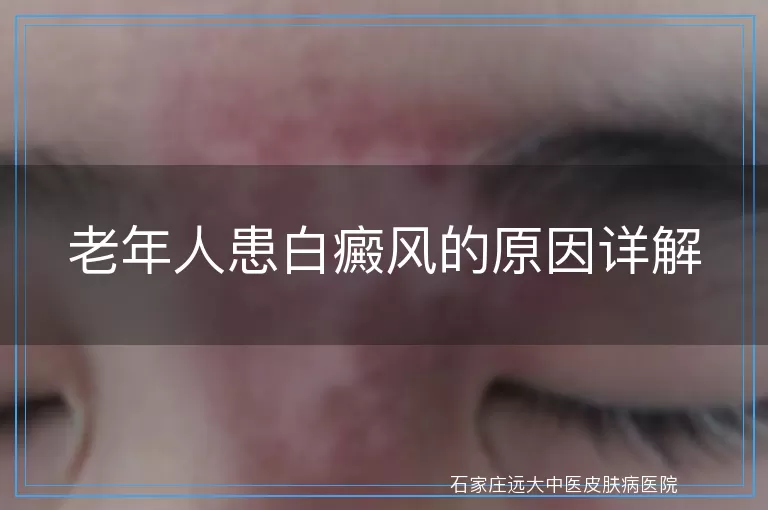 老年人患白癜风的原因详解