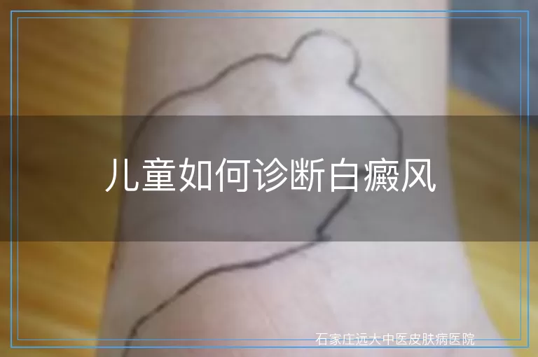 儿童如何诊断白癜风