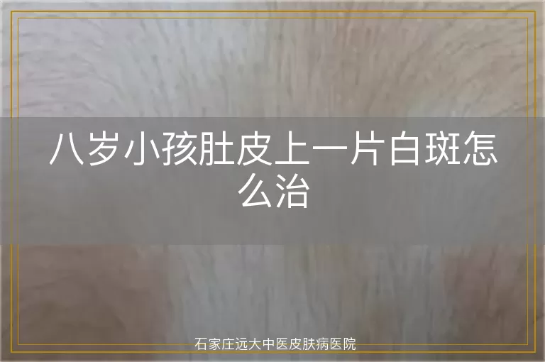 八岁小孩肚皮上一片白斑怎么治