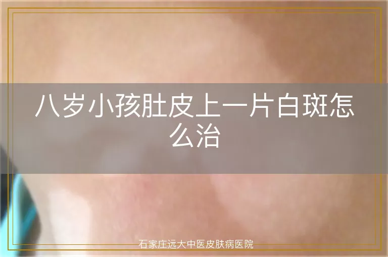 八岁小孩肚皮上一片白斑怎么治