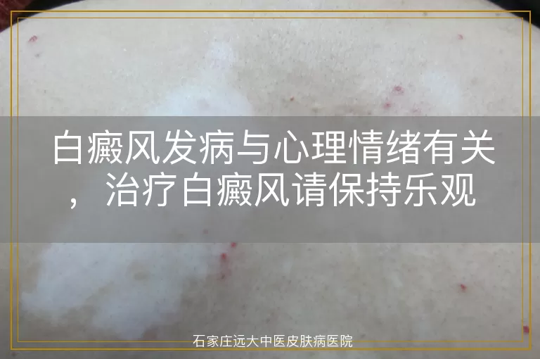 白癜风发病与心理情绪有关，治疗白癜风请保持乐观