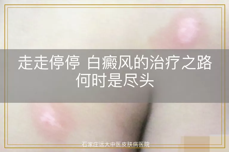 走走停停 白癜风的治疗之路何时是尽头
