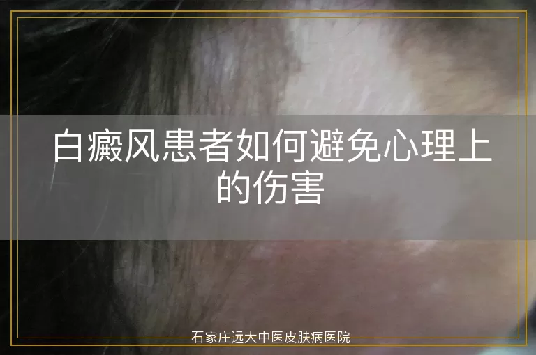 白癜风患者如何避免心理上的伤害