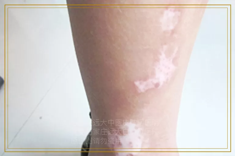 白癜风患者的心理