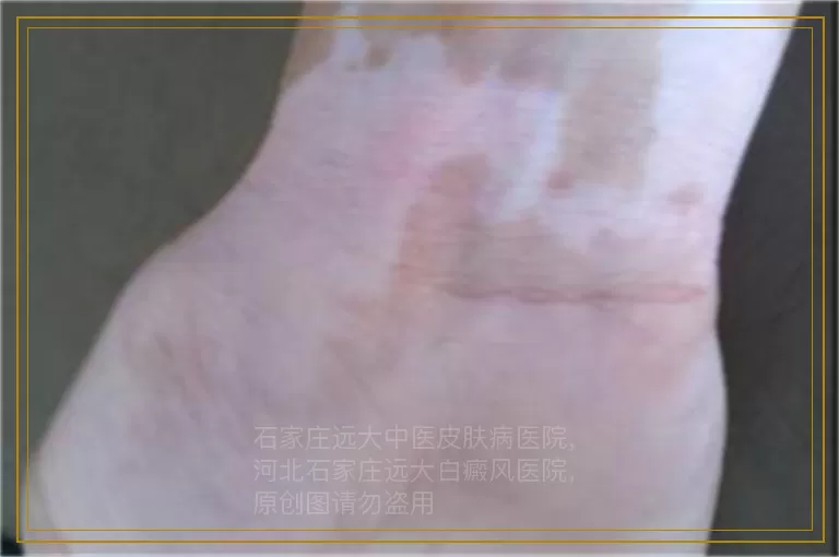 白癜风患者的心理障碍表现及应对措施