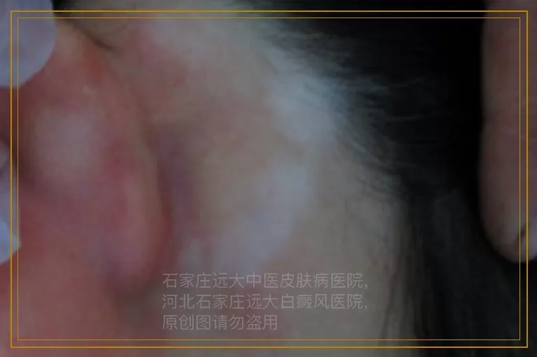 白癜风的心理调节