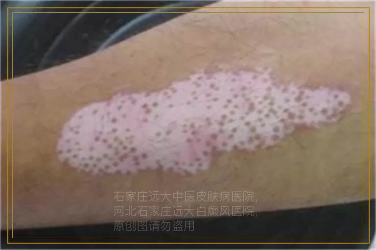伍德氏灯照白斑照出来的颜色对应表