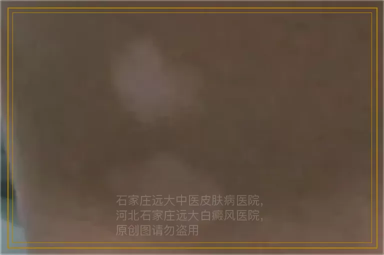 白癜风对人体美观造成的伤害体现在那些方面？