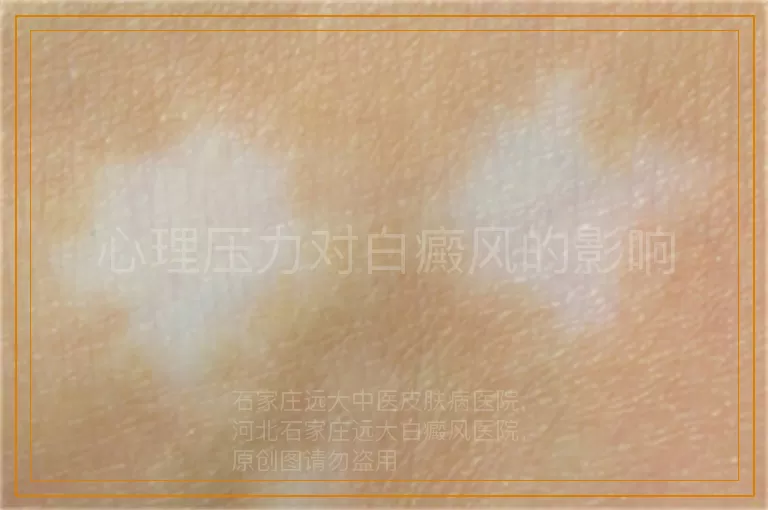心理压力对白癜风的影响