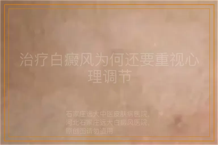 治疗白癜风为何还要重视心理调节