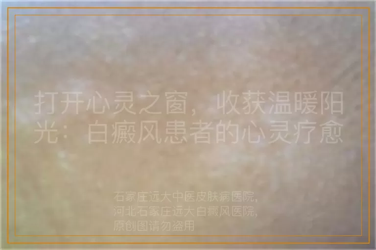 打开心灵之窗，收获温暖阳光：白癜风患者的心灵疗愈之路