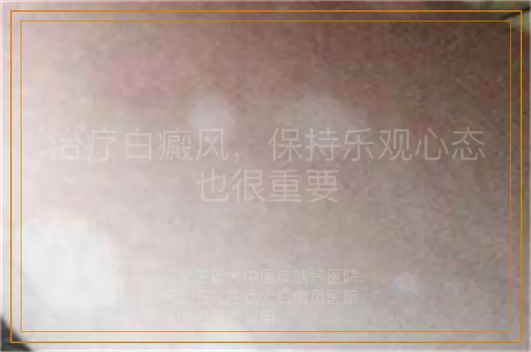 治疗白癜风，保持乐观心态也很重要