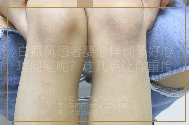 白癜风患者要怎样调节好心理问题呢？这几点让你重拾阳光