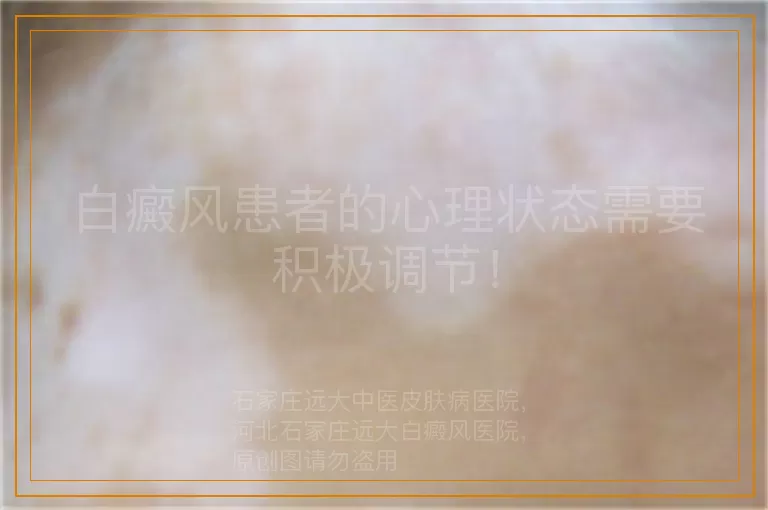 白癜风患者的心理状态需要积极调节！