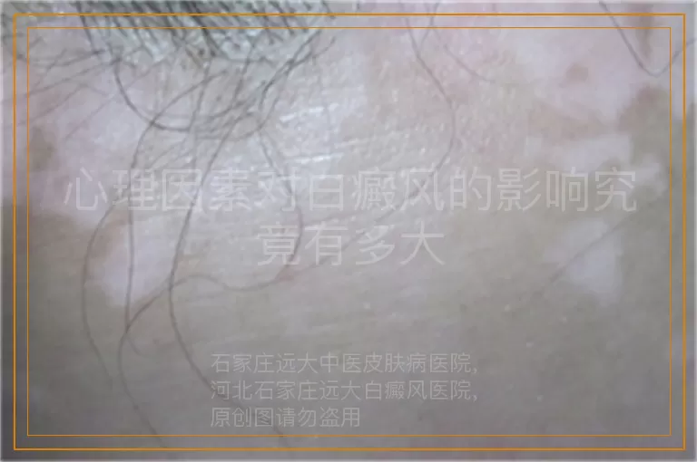 心理因素对白癜风的影响究竟有多大