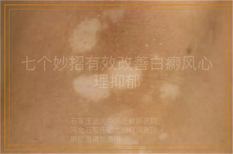 七个妙招有效改善白癜风心理抑郁