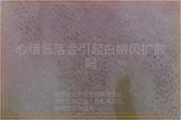 心情低落会引起白癜风扩散吗