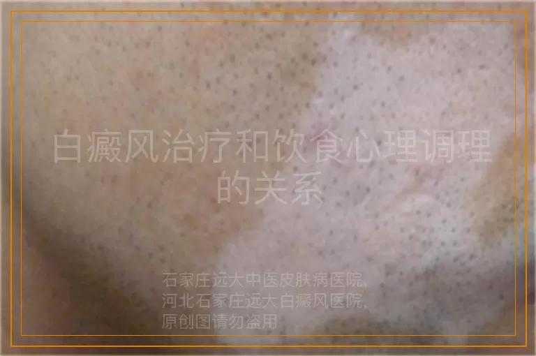 白癜风治疗和饮食心理调理的关系