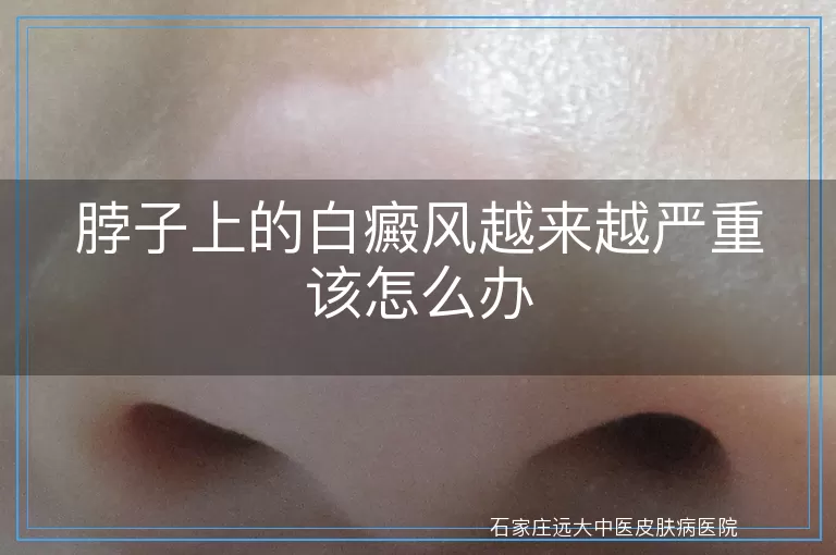 脖子上的白癜风越来越严重该怎么办