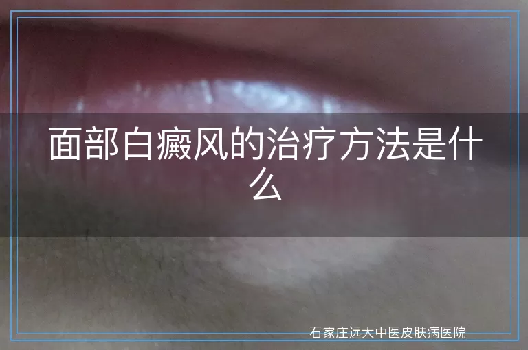 面部白癜风的治疗方法是什么