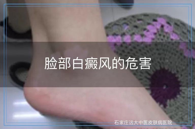 脸部白癜风的危害