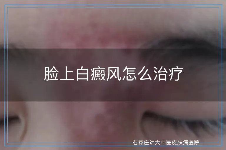 脸上白癜风怎么治疗