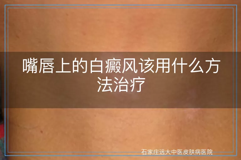 嘴唇上的白癜风该用什么方法治疗