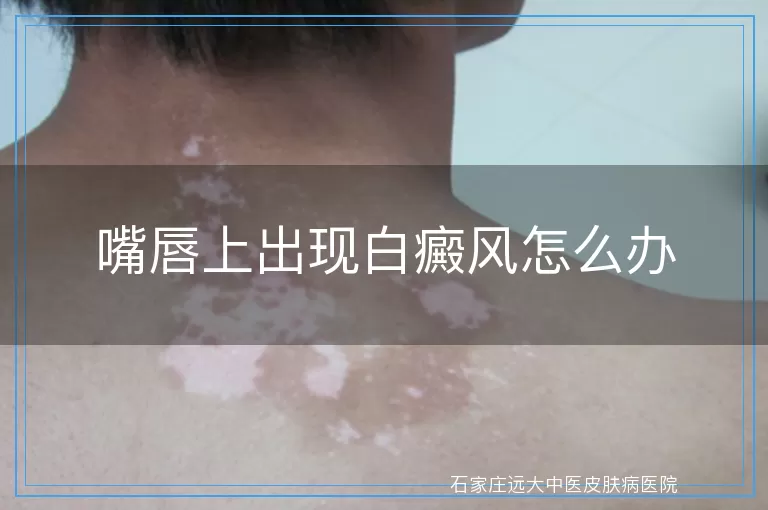 嘴唇上出现白癜风怎么办