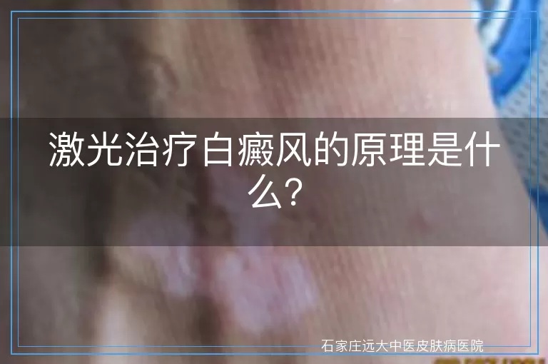 激光治疗白癜风的原理是什么？