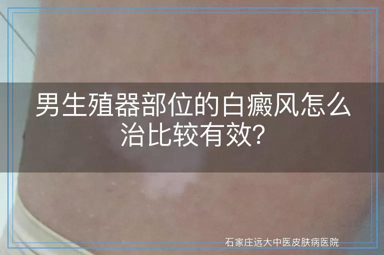 男生殖器部位的白癜风怎么治比较有效？