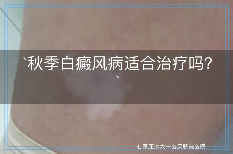秋季白癜风病适合治疗吗？