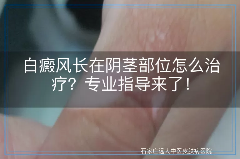 白癜风长在阴茎部位怎么治疗？专业指导来了！