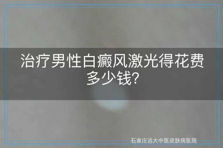 治疗男性白癜风激光得花费多少钱？
