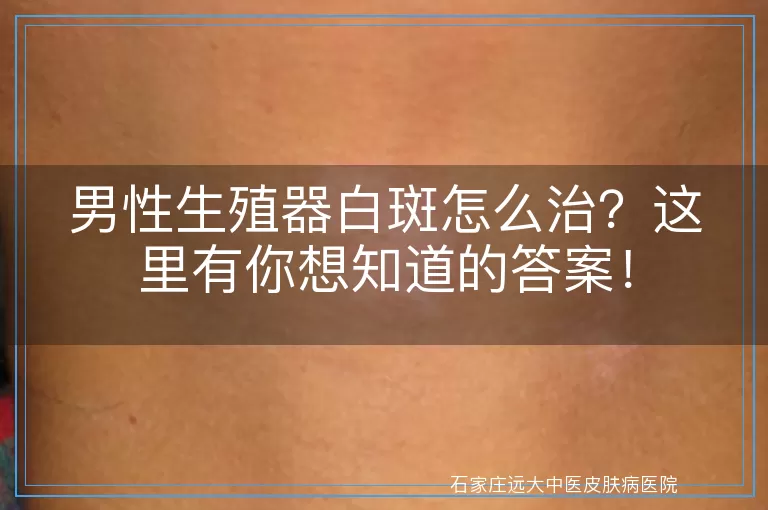 男性生殖器白斑怎么治？这里有你想知道的答案！