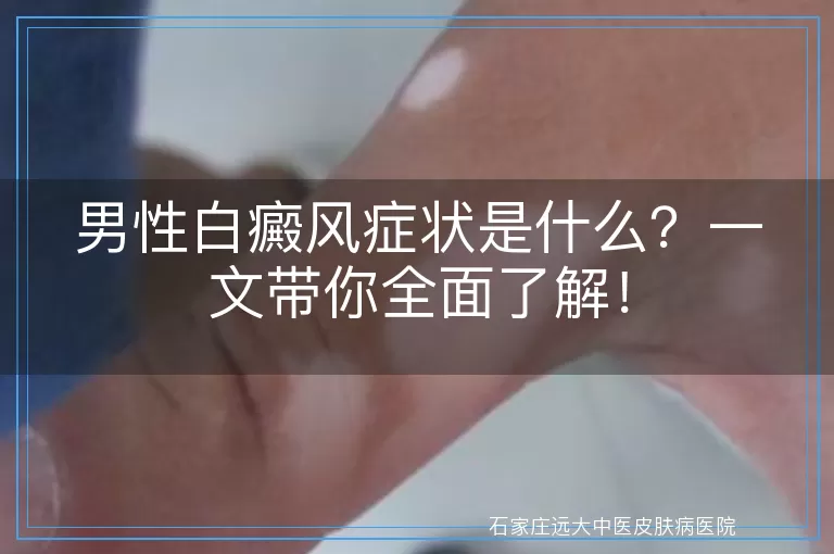 男性白癜风症状是什么？一文带你全面了解！