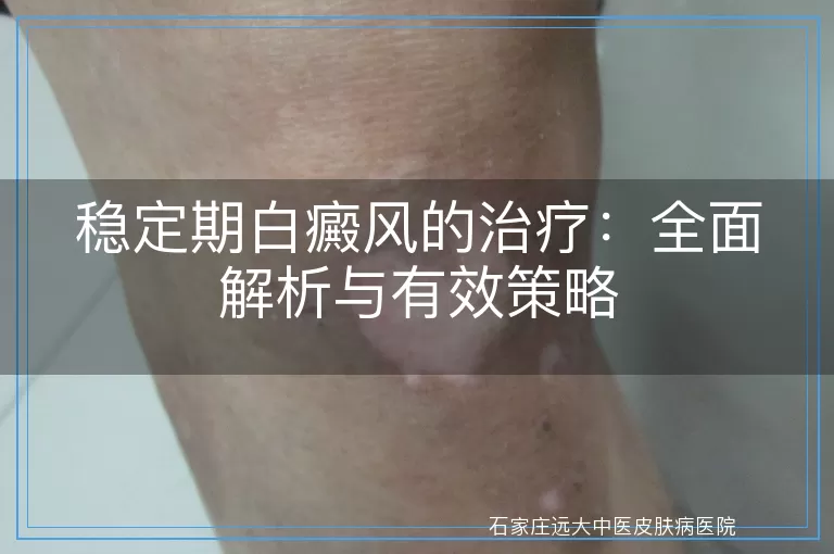 稳定期白癜风的治疗：全面解析与有效策略