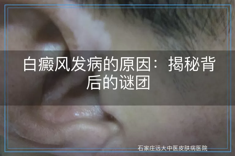 白癜风发病的原因：揭秘背后的谜团
