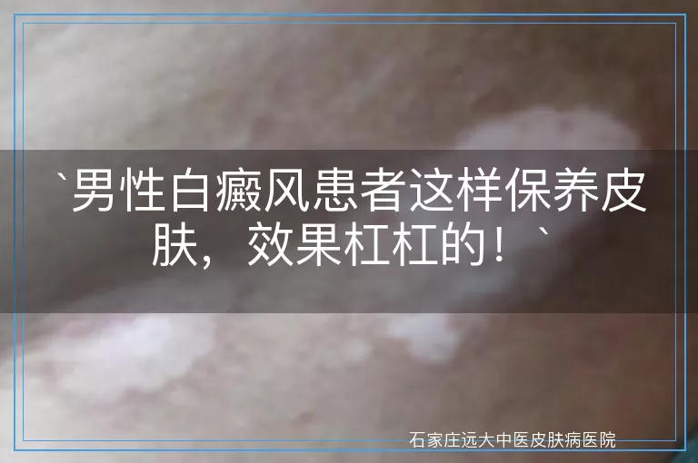 男性白癜风患者这样保养皮肤，效果杠杠的！