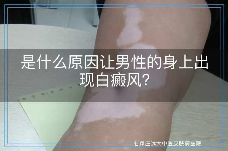 是什么原因让男性的身上出现白癜风？