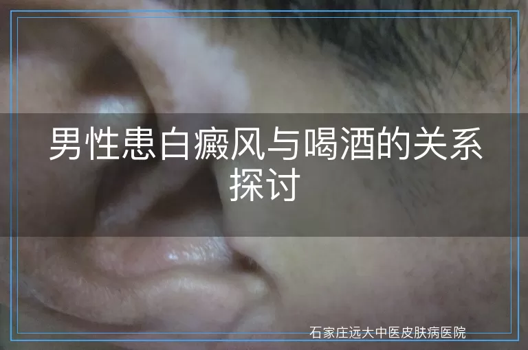 男性患白癜风与喝酒的关系探讨