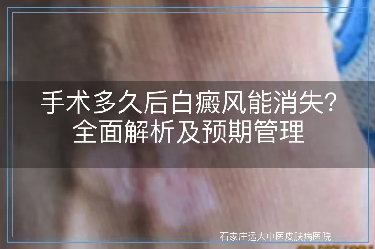 手术多久后白癜风能消失？全面解析及预期管理