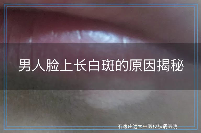 男人脸上长白斑的原因揭秘