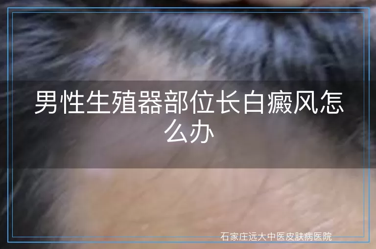 男性生殖器部位长白癜风怎么办