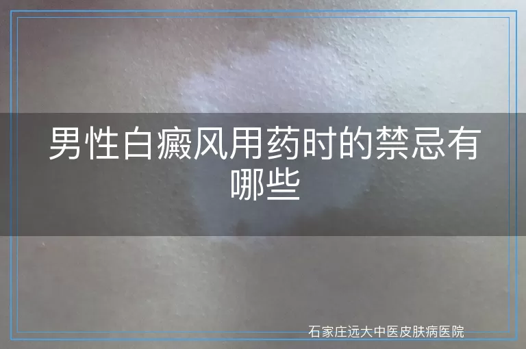 男性白癜风用药时的禁忌有哪些