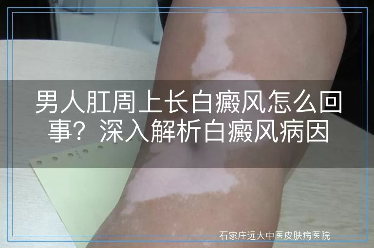 男人肛周上长白癜风怎么回事？深入解析白癜风病因