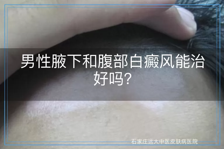 男性腋下和腹部白癜风能治好吗？