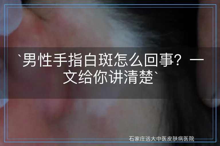 男性手指白斑怎么回事？一文给你讲清楚